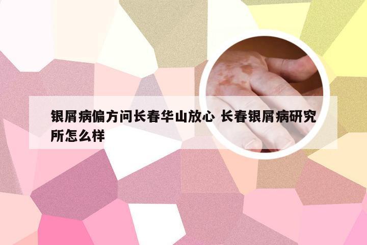 银屑病偏方问长春华山放心 长春银屑病研究所怎么样