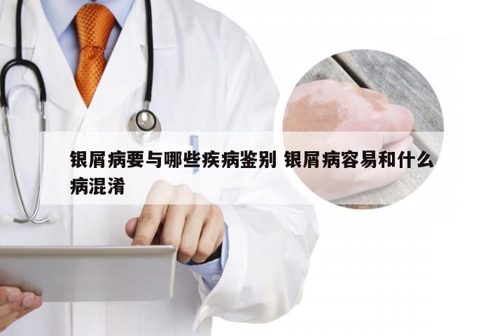 银屑病要与哪些疾病鉴别 银屑病容易和什么病混淆