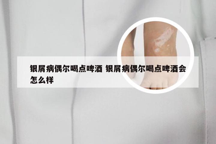 银屑病偶尔喝点啤酒 银屑病偶尔喝点啤酒会怎么样