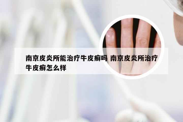 南京皮炎所能治疗牛皮癣吗 南京皮炎所治疗牛皮癣怎么样