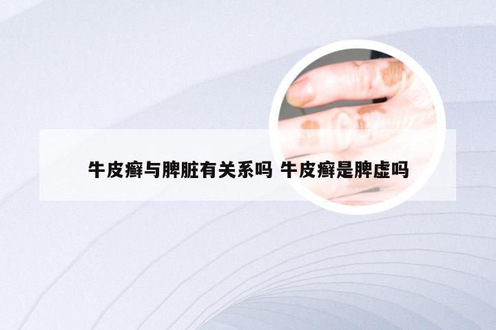 牛皮癣与脾脏有关系吗 牛皮癣是脾虚吗