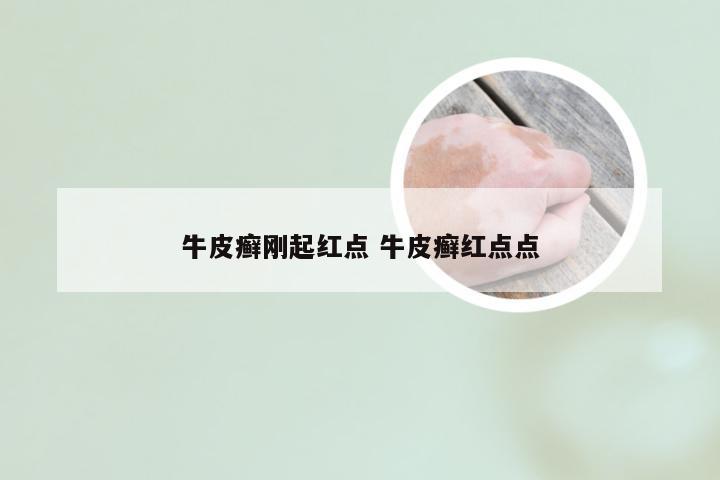 牛皮癣刚起红点 牛皮癣红点点