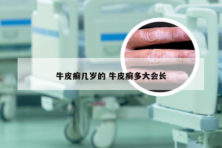 牛皮癣几岁的 牛皮癣多大会长