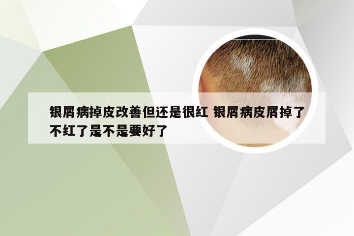 银屑病掉皮改善但还是很红 银屑病皮屑掉了不红了是不是要好了