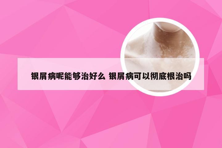 银屑病呢能够治好么 银屑病可以彻底根治吗