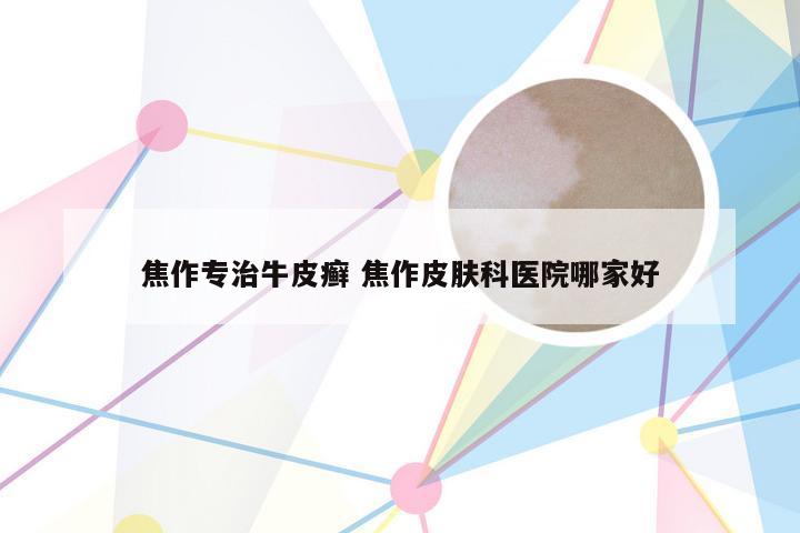 焦作专治牛皮癣 焦作皮肤科医院哪家好