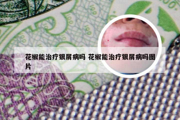 花椒能治疗银屑病吗 花椒能治疗银屑病吗图片