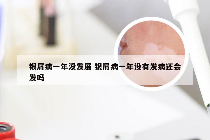 银屑病一年没发展 银屑病一年没有发病还会发吗