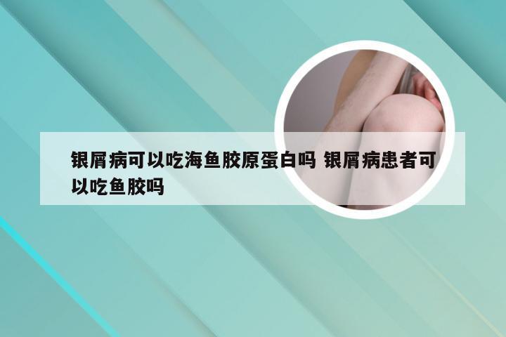 银屑病可以吃海鱼胶原蛋白吗 银屑病患者可以吃鱼胶吗