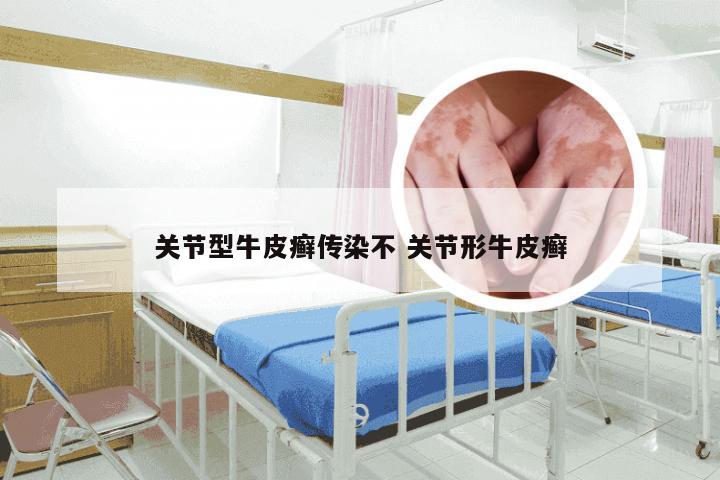 关节型牛皮癣传染不 关节形牛皮癣