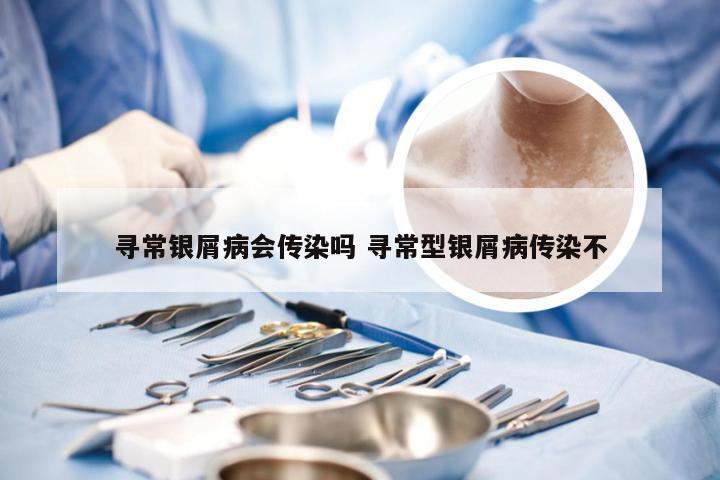 寻常银屑病会传染吗 寻常型银屑病传染不