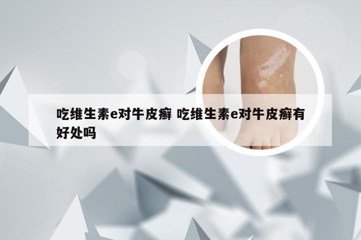 吃维生素e对牛皮癣 吃维生素e对牛皮癣有好处吗