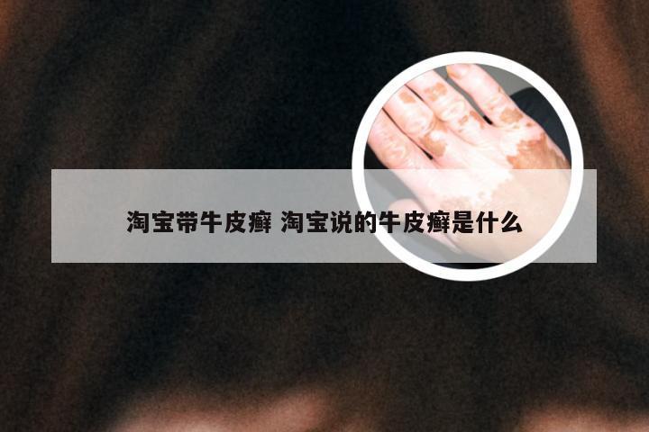 淘宝带牛皮癣 淘宝说的牛皮癣是什么