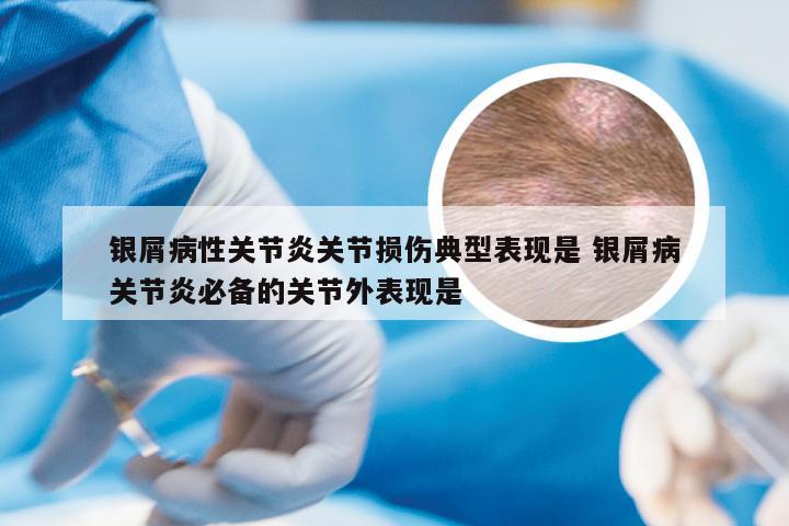 银屑病性关节炎关节损伤典型表现是 银屑病关节炎必备的关节外表现是