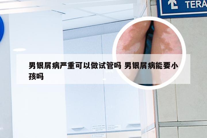 男银屑病严重可以做试管吗 男银屑病能要小孩吗