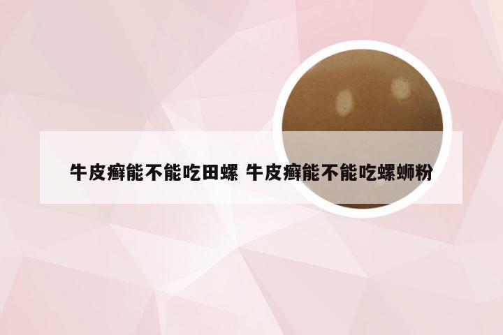 牛皮癣能不能吃田螺 牛皮癣能不能吃螺蛳粉