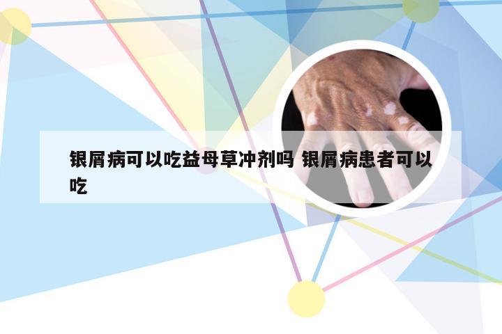 银屑病可以吃益母草冲剂吗 银屑病患者可以吃