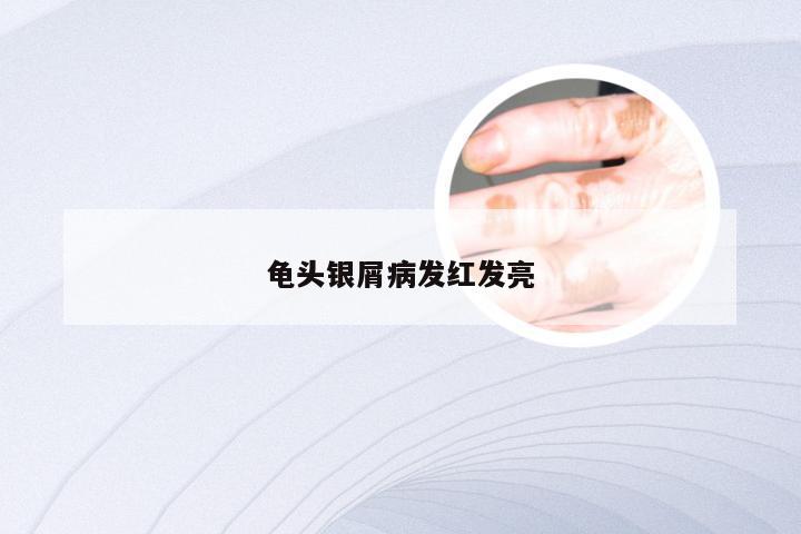龟头银屑病发红发亮