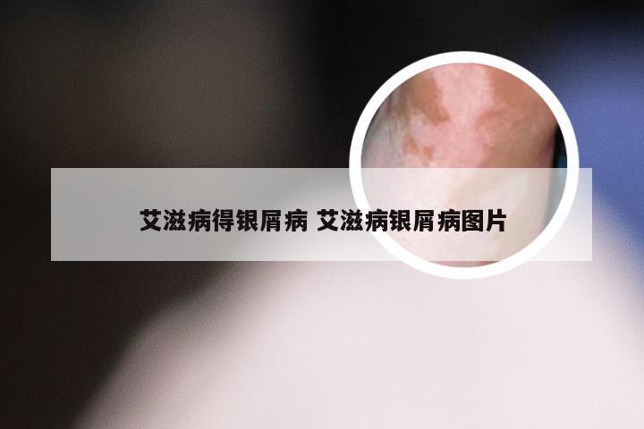 艾滋病得银屑病 艾滋病银屑病图片