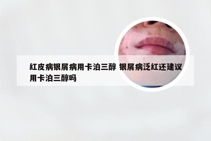 红皮病银屑病用卡泊三醇 银屑病泛红还建议用卡泊三醇吗