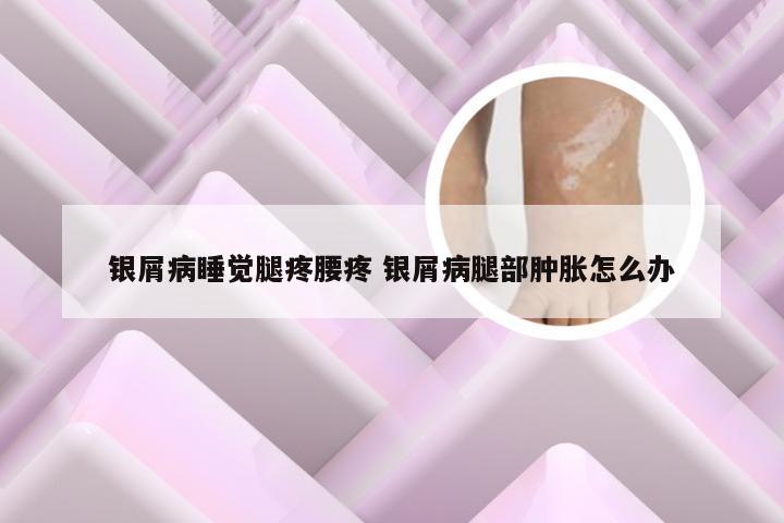 银屑病睡觉腿疼腰疼 银屑病腿部肿胀怎么办