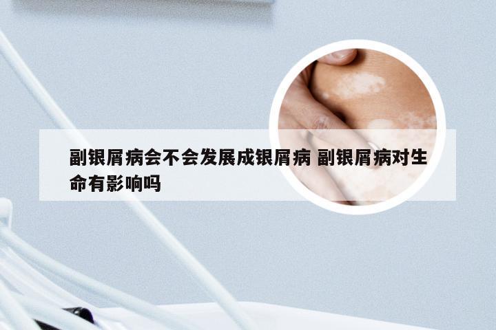 副银屑病会不会发展成银屑病 副银屑病对生命有影响吗