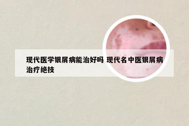 现代医学银屑病能治好吗 现代名中医银屑病治疗绝技