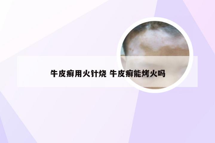 牛皮癣用火针烧 牛皮癣能烤火吗