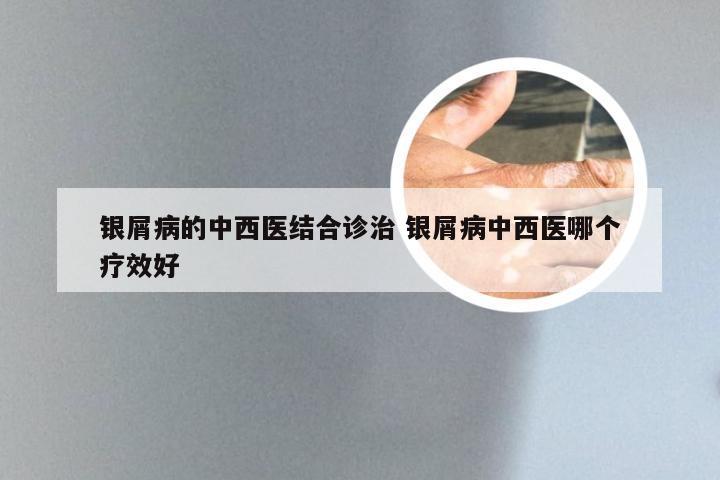 银屑病的中西医结合诊治 银屑病中西医哪个疗效好