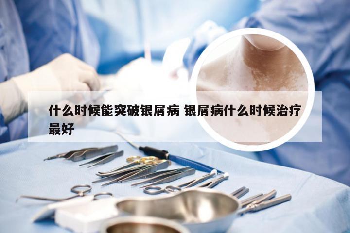 什么时候能突破银屑病 银屑病什么时候治疗最好