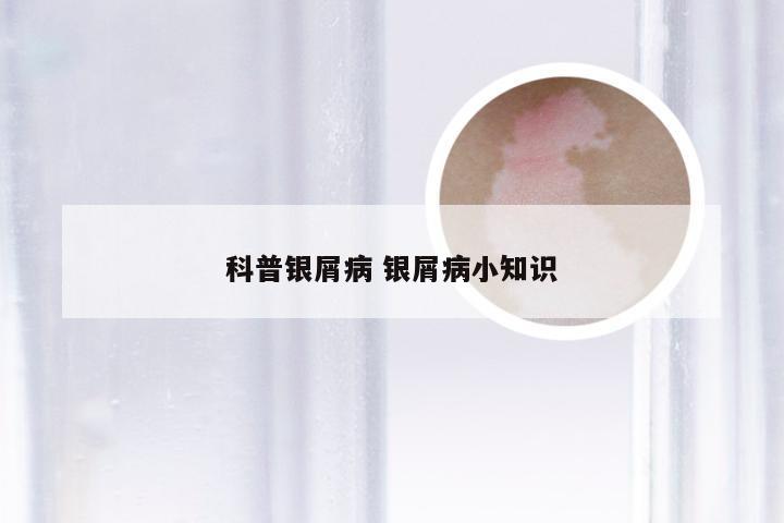 科普银屑病 银屑病小知识