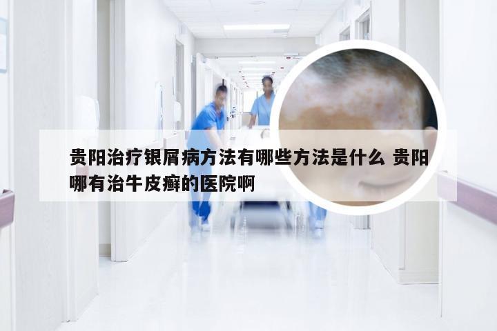 贵阳治疗银屑病方法有哪些方法是什么 贵阳哪有治牛皮癣的医院啊