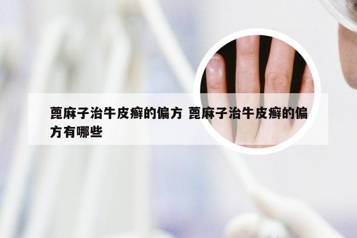 蓖麻子治牛皮癣的偏方 蓖麻子治牛皮癣的偏方有哪些