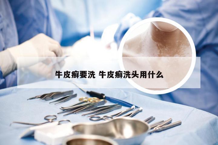 牛皮癣要洗 牛皮癣洗头用什么