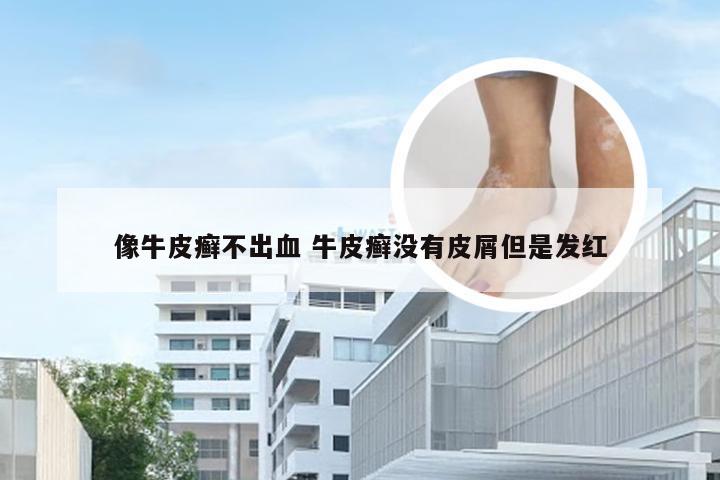 像牛皮癣不出血 牛皮癣没有皮屑但是发红