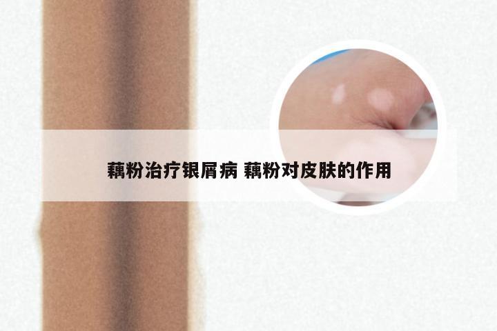 藕粉治疗银屑病 藕粉对皮肤的作用