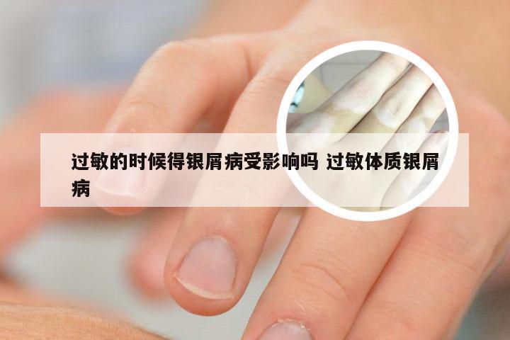 过敏的时候得银屑病受影响吗 过敏体质银屑病