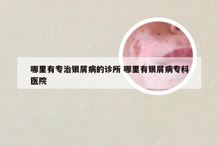 哪里有专治银屑病的诊所 哪里有银屑病专科医院