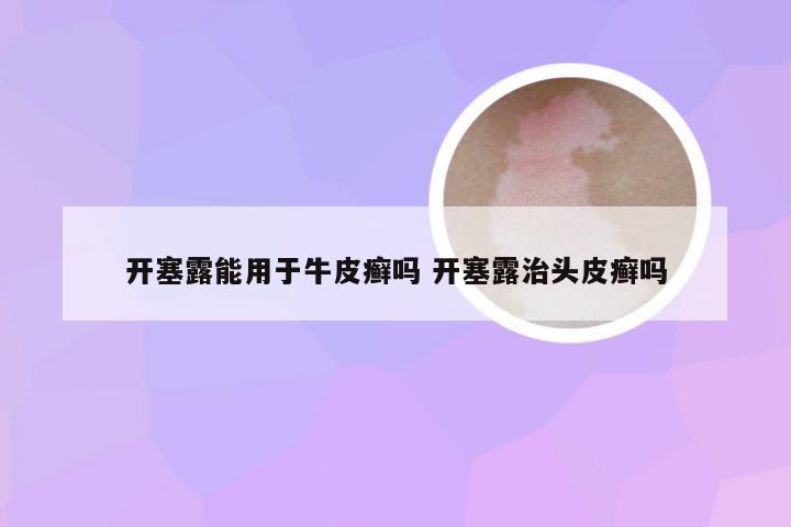 开塞露能用于牛皮癣吗 开塞露治头皮癣吗