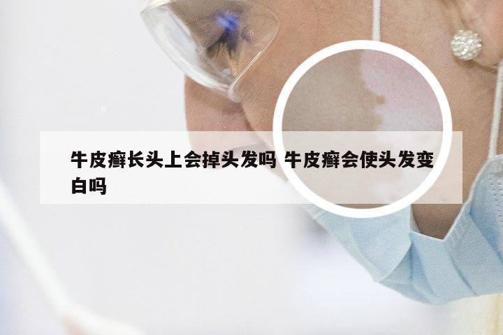 牛皮癣长头上会掉头发吗 牛皮癣会使头发变白吗
