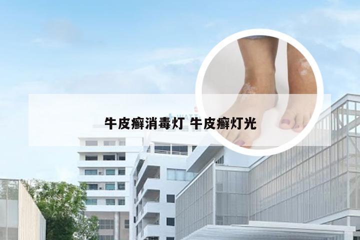 牛皮癣消毒灯 牛皮癣灯光