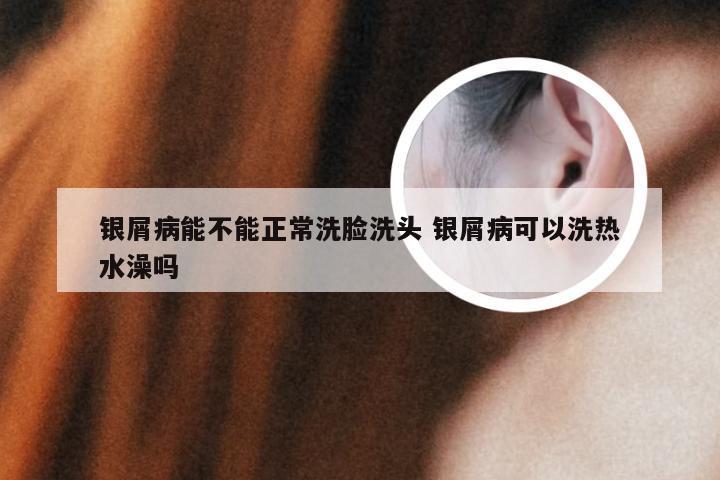 银屑病能不能正常洗脸洗头 银屑病可以洗热水澡吗