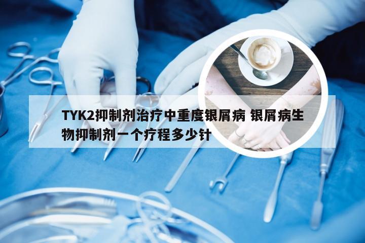 TYK2抑制剂治疗中重度银屑病 银屑病生物抑制剂一个疗程多少针
