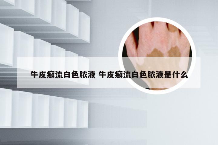 牛皮癣流白色脓液 牛皮癣流白色脓液是什么