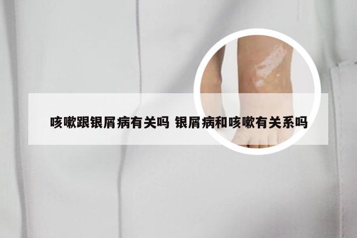 咳嗽跟银屑病有关吗 银屑病和咳嗽有关系吗