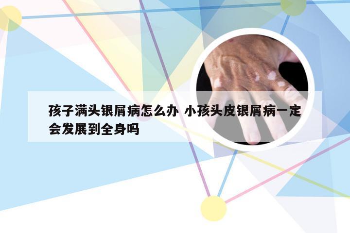 孩子满头银屑病怎么办 小孩头皮银屑病一定会发展到全身吗