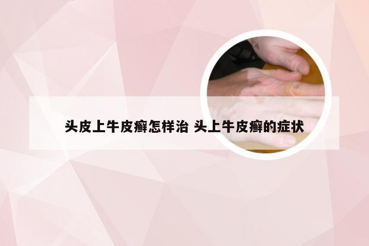 头皮上牛皮癣怎样治 头上牛皮癣的症状