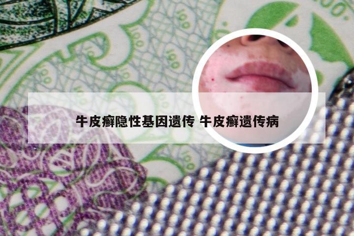 牛皮癣隐性基因遗传 牛皮癣遗传病