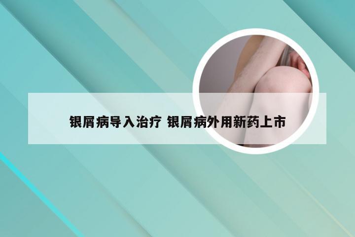 银屑病导入治疗 银屑病外用新药上市