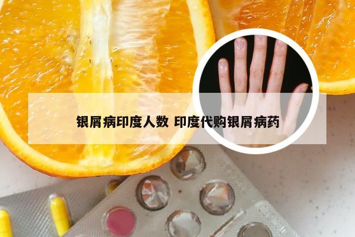 银屑病印度人数 印度代购银屑病药